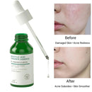 Salicylic Acid Pore Shrinking Essence Anti-acne Exfoliating Blackhead Remover Face Spot Removal Essence Beauty Health Skin Care
