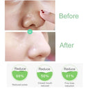 Salicylic Acid Pore Shrinking Essence Anti-acne Exfoliating Blackhead Remover Face Spot Removal Essence Beauty Health Skin Care