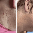DERMORA™ Skin Tag Remover