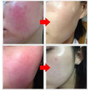 Facial Redness Repair Serum Improve Sensitive Skin Dryness Moisturizer Hydrating Sooth Lotion Removal Rosacea Korean Cosmetics