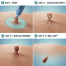 DERMORA™ Skin Tag Remover