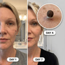 DERMORA™ Skin Tag Remover